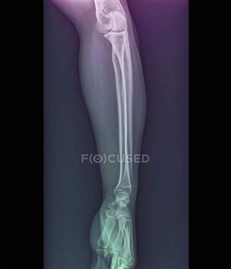 Normal Elbow And Wrist Joints X Ray — Ulna Diagnostic Stock Photo