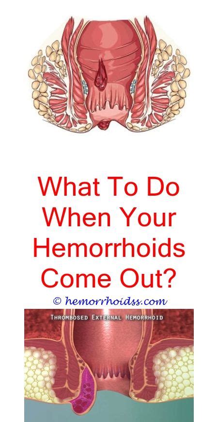 Pin On Hemorrhoid Remedies