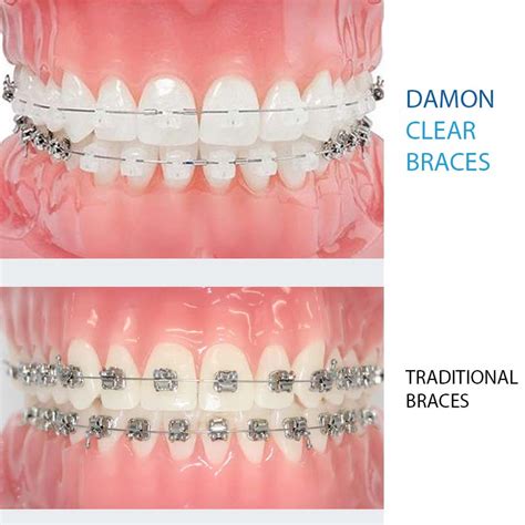 Damon Clear Braces Specialist Orthodontist In Kingston London