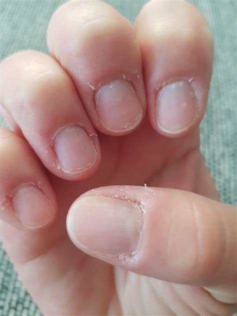 Embarrassing Fingernail Help Needed What Can I Use To Help My Nails 2
