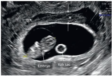 Placenta And Umbilical Cord Radiology Key