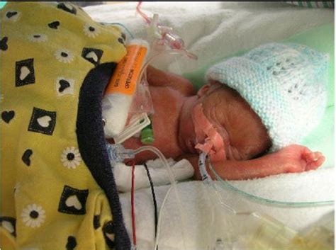 Worlds Most Premature Twins Born At 22 Weeks Defy The Odds Turn 9 Years Old