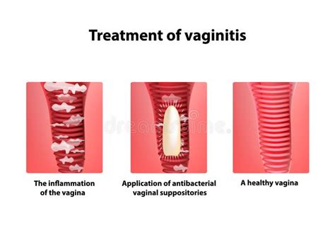 Tratamiento De Los Supositorios Del Vaginitis Inflamación La Vagina