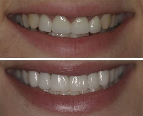 Gum Treatment Cosmetic Teeth Veneers Teeth Fix Teeth