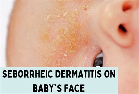 Seborrheic Dermatitis On Face Treatment Causes Symptoms