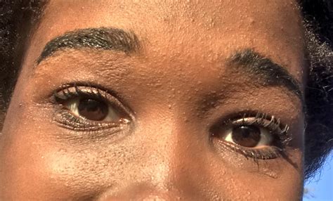 I Need Some Advice On My Skin Under My Eyebrows The Skin Has Become