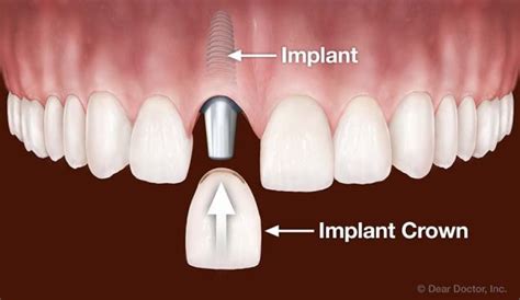 Dental Implants In Nyc Advanced Periodontics Nj