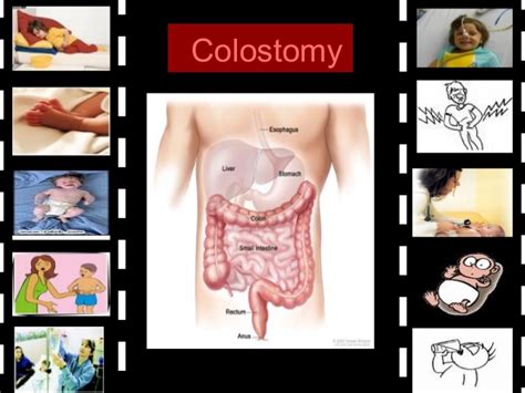 Your doctor or ostomy nurse will teach you how to irrigate your colostomy. Colostomy