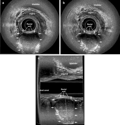 Endoanal Ultrasonographic Imaging Of The Anorectal Cysts And Masses Radiology Key