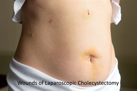 Laparoscopic Cholecystectomy In Singapore Ls Lee Surgery Clinic