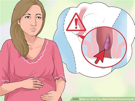 External hemorrhoids are visible from the outside. How to Tell if You Have Internal Hemorrhoids: 9 Steps