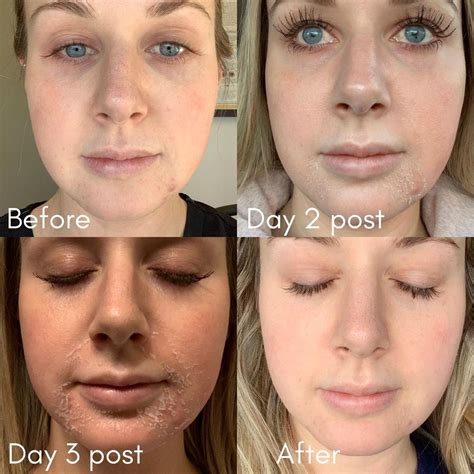 Chemical Peels Chemical Peeling Chemical Peel Before And After