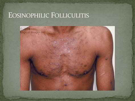Hiv Folliculitis