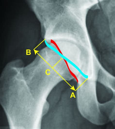 The Relevance Of The Radiological Signs Of Acetabular Retroversion