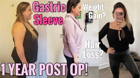 Gastric Sleeve Surgery 1 Year Post Op Weight Gain Hair Loss Loose Skin Youtube