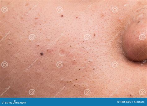 Closed Up Of Pimple Blackheads On The Cheek Stock Photo Image Of