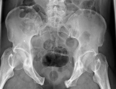 Pelvic Fracture X Ray Photograph By Du Cane Medical Imaging Ltd Fine