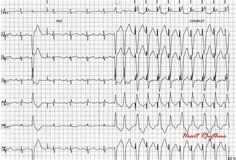 Ecg Rhythms Wide Qrs Tachycardia Wqrst In A Patient With A Pacemaker