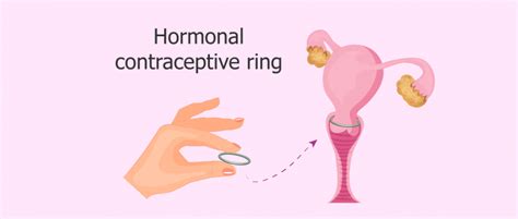 Birth Control Options The Contraceptive Ring