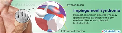 Impingement Syndrome Treatment Exercise Home Remedies