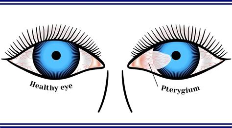 What Is A Pterygium Eastside Eye