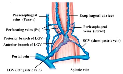 Esophageal Varices Anatomy
