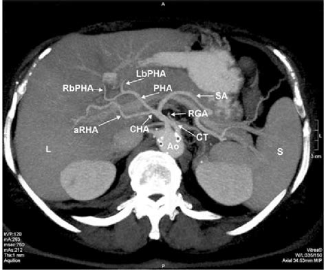 Liver Segmental Anatomy Ct Scan