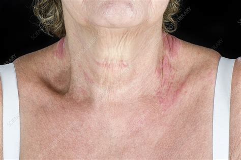 Eczema On The Neck Stock Image C0460998 Science Photo Library