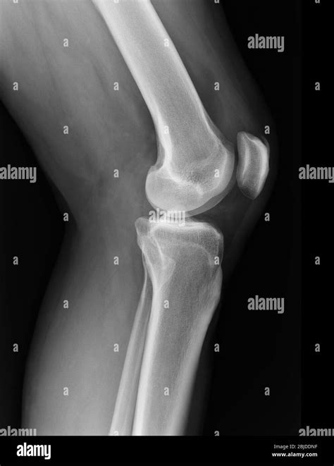 X Ray Knee Radiograph Show State Of Injury Stock Photo Alamy