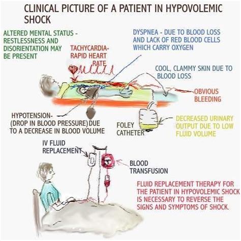 The Patient In Hypovolemic Shock Sessions 9 May Display The Above