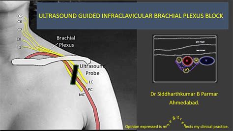 Ultrasound Guided Infraclavicular Brachial Plexus Block Youtube