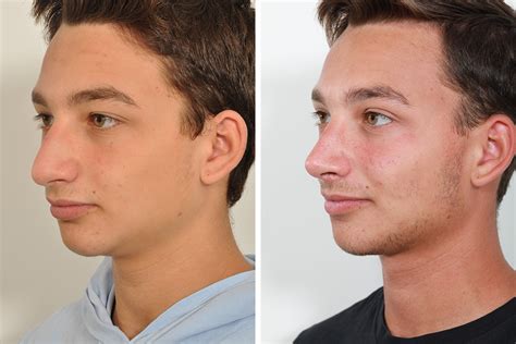 Nose job check tiktok compilation. Rhinoplasty, Nose Surgery, Nose Job for Men in New York ...