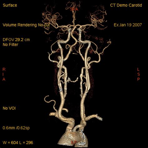 Ct Scan Computerized Tomography In Anand Angiography In Anand Gujarat