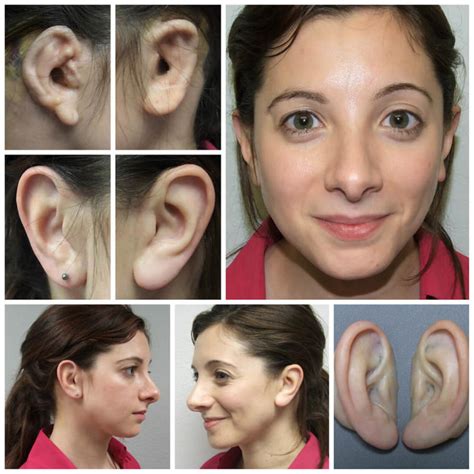 Microtia Ear Prosthetics Feel More Confident And Comfortable