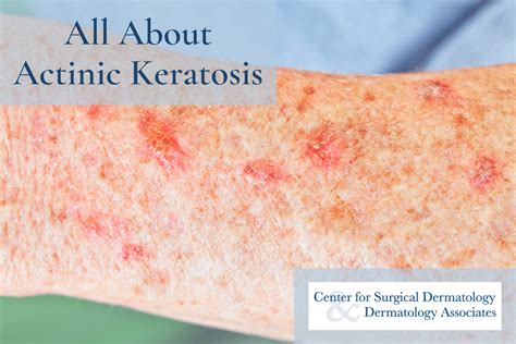 Actinic Keratosis The Common Precancer You Should Know About Center