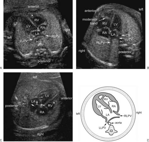 Detection of fetal anomalies using ultrasound (us) has evolved as the us equipment and probes have evolved. Situs Inversus Fetal Ultrasound Images