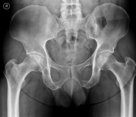 Avascular Necrosis Of The Femoral Head Radiology Case Radiopaedia Org