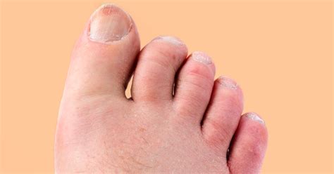 Psoriatic Arthritis In Your Toes Pictures Symptoms And Treatment