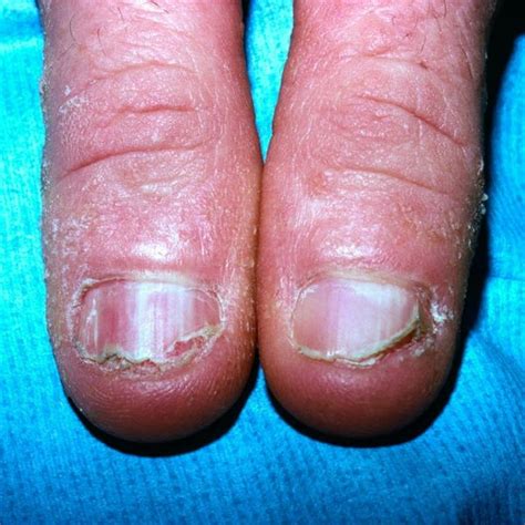 Nail Deformities And Dystrophies Dermatologic Disorders Merck