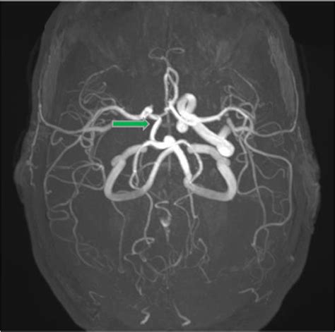 Agenesis Of The Right Internal Carotid Artery Associated With Ipsilateral Raeder Syndrome First