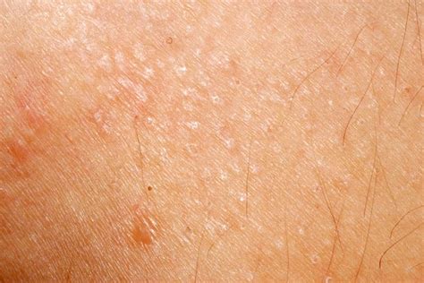 Dry Bumps On Skin Rash How To Choose And Use The Best