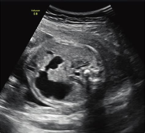 Double Bubble Sign Of Duodenal Obstruction On A Prenatal Ultrasound Download Scientific Diagram
