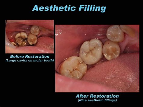 Composite Resinaesthetic White Filling Prestige Dental My