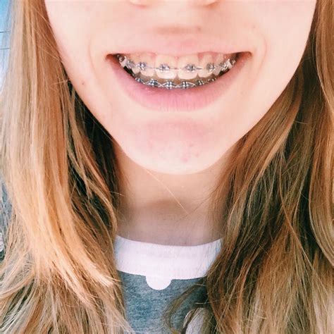 How To Put Rubber Bands On Braces Triangle Dunya Led