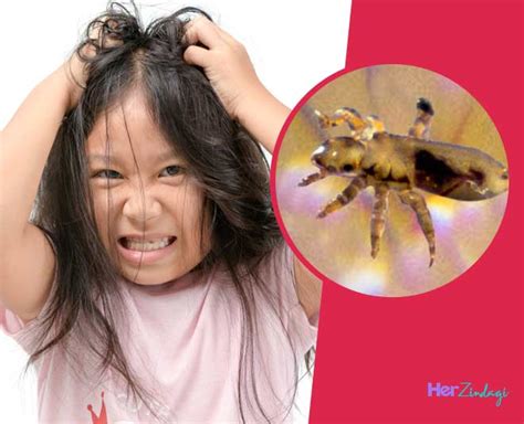 How To Get Rid Of Lice Super Fast How To Get Rid Of Lice Super Fast