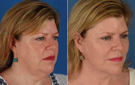The Uplift Lower Face And Neck Lift Photos Naples Fl Patient