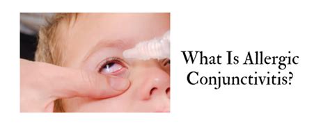 What Is Allergic Conjunctivitis Health Issues