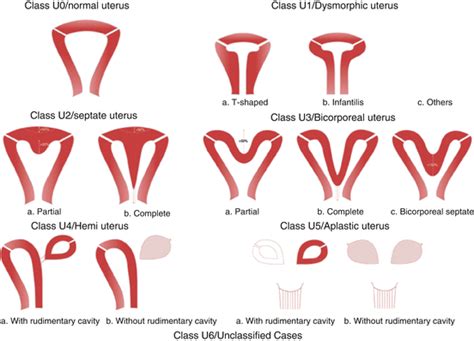 Abnormal Development Of The Female Genital Tract Obgyn Key