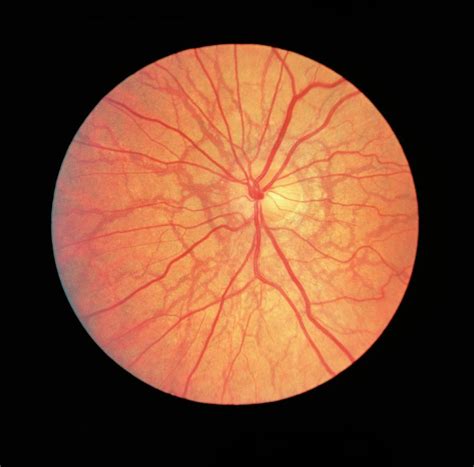 Ophthalmoscope View Of Retina With Angioid Streaks Photograph By Paul