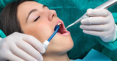 ¿qué Es Un Curetaje Dental Dental Cerro Alonso